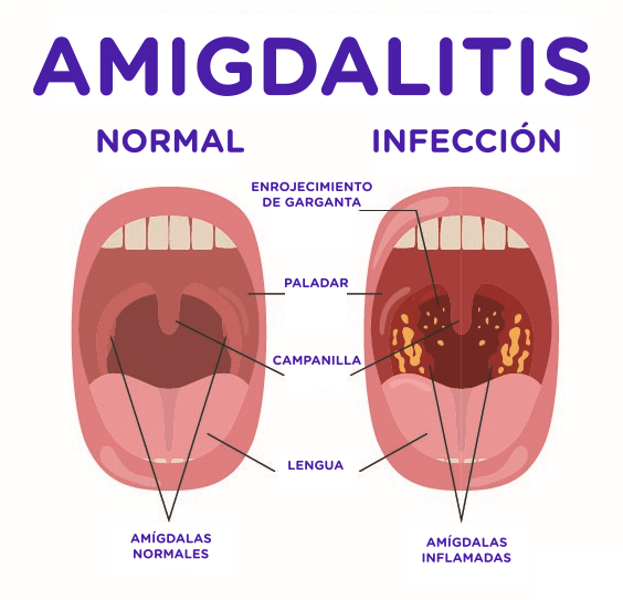 Amigdalitis