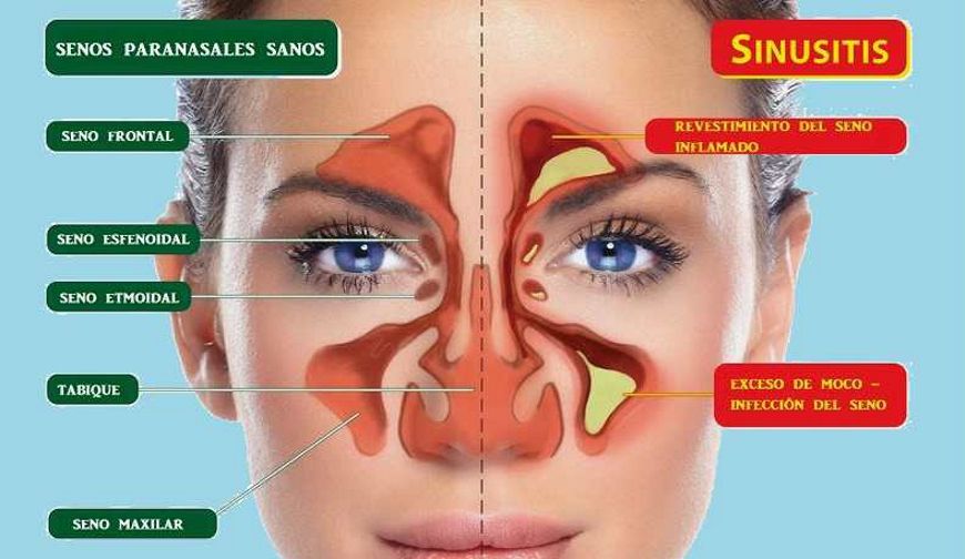Guía de salud sobre  sinusitis