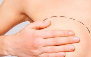 Beneficios de la mamoplastia de aumento